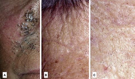 Sebaceous hyperplasia is a very common non-contagious skin condition. . Agent orange skin rash pictures